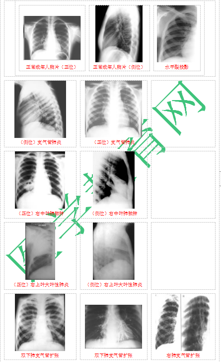 快收藏！臨床助理醫(yī)師實踐技能62個胸片（圖片診斷）