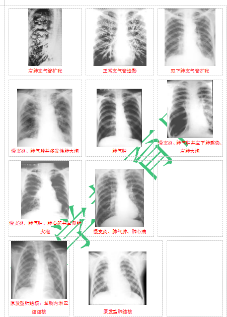 快收藏！臨床助理醫(yī)師實踐技能62個胸片（圖片診斷）